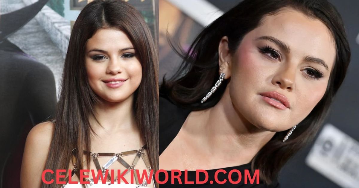 Selena Gomez disease name
